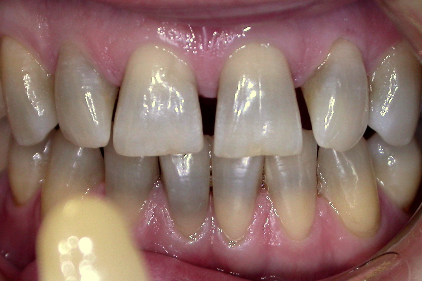 Bruns Family Dental Center | ViziLite reg Cancer Screening, Oral Exams and Digital Radiography