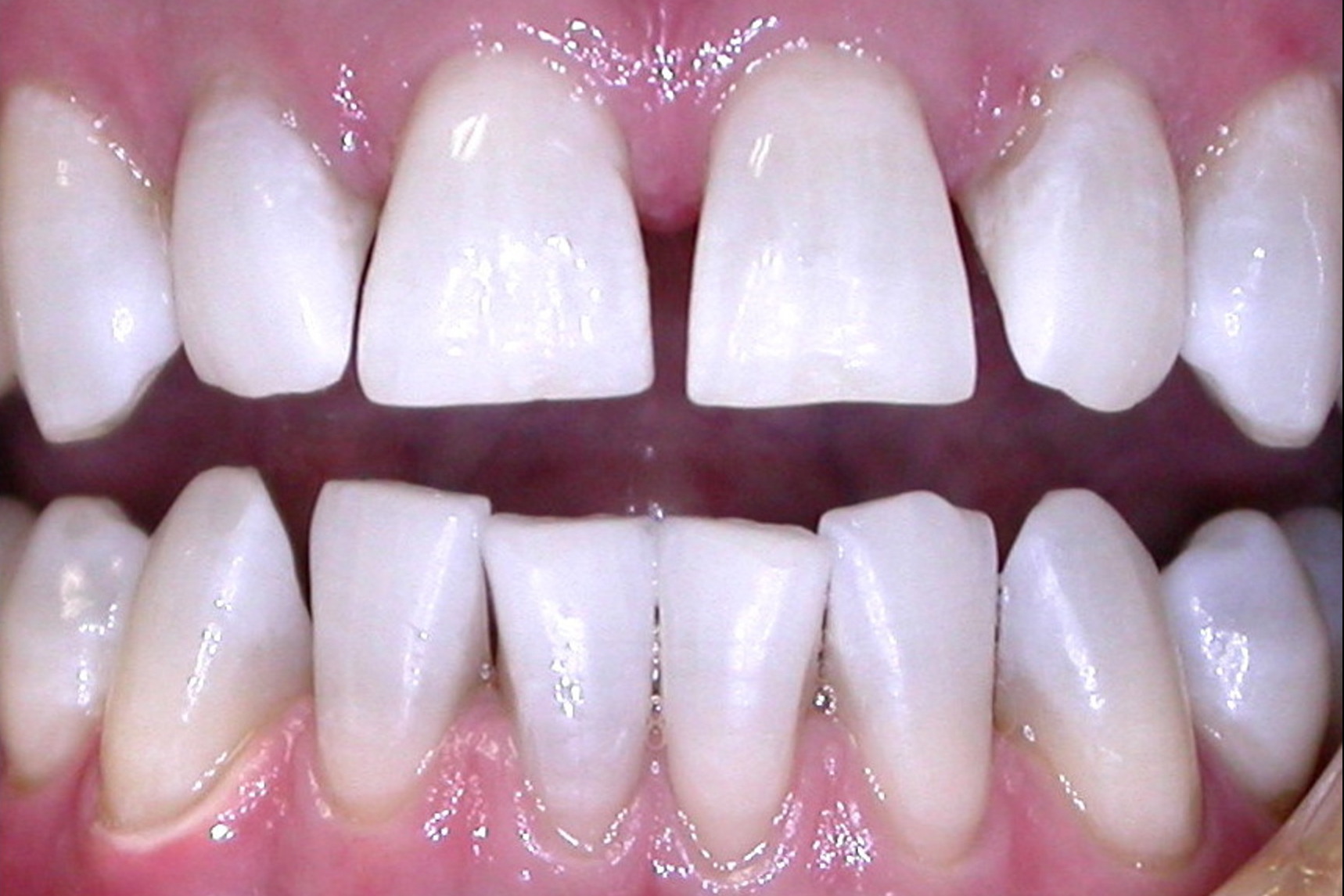 Bruns Family Dental Center | Dental Crowns, K R Whitening and Teeth Whitening