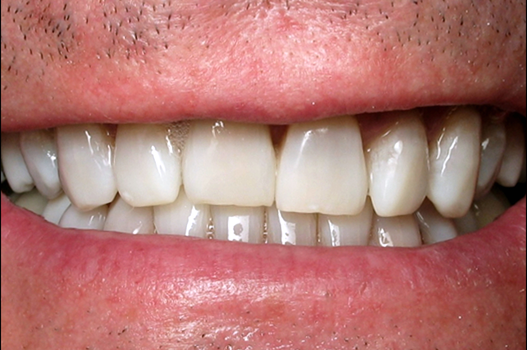 Bruns Family Dental Center | Extractions, Veneers and ViziLite reg Cancer Screening