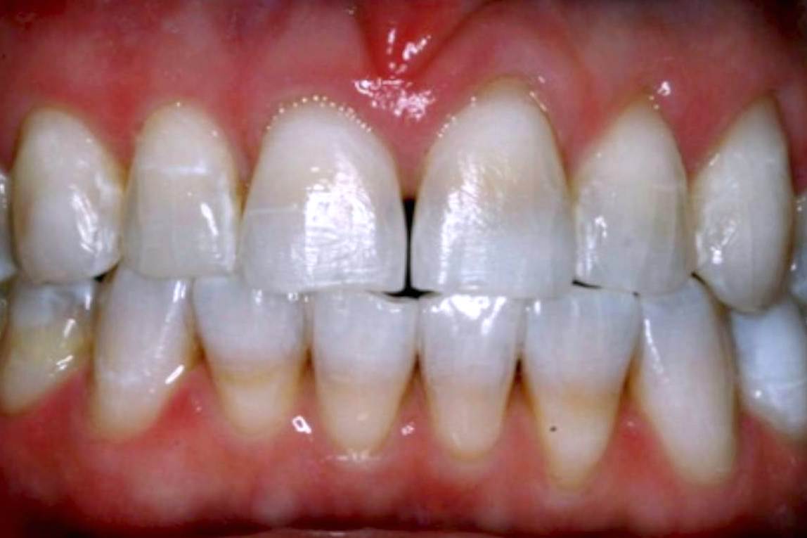 Bruns Family Dental Center | Dental Fillings, Veneers and Dentures