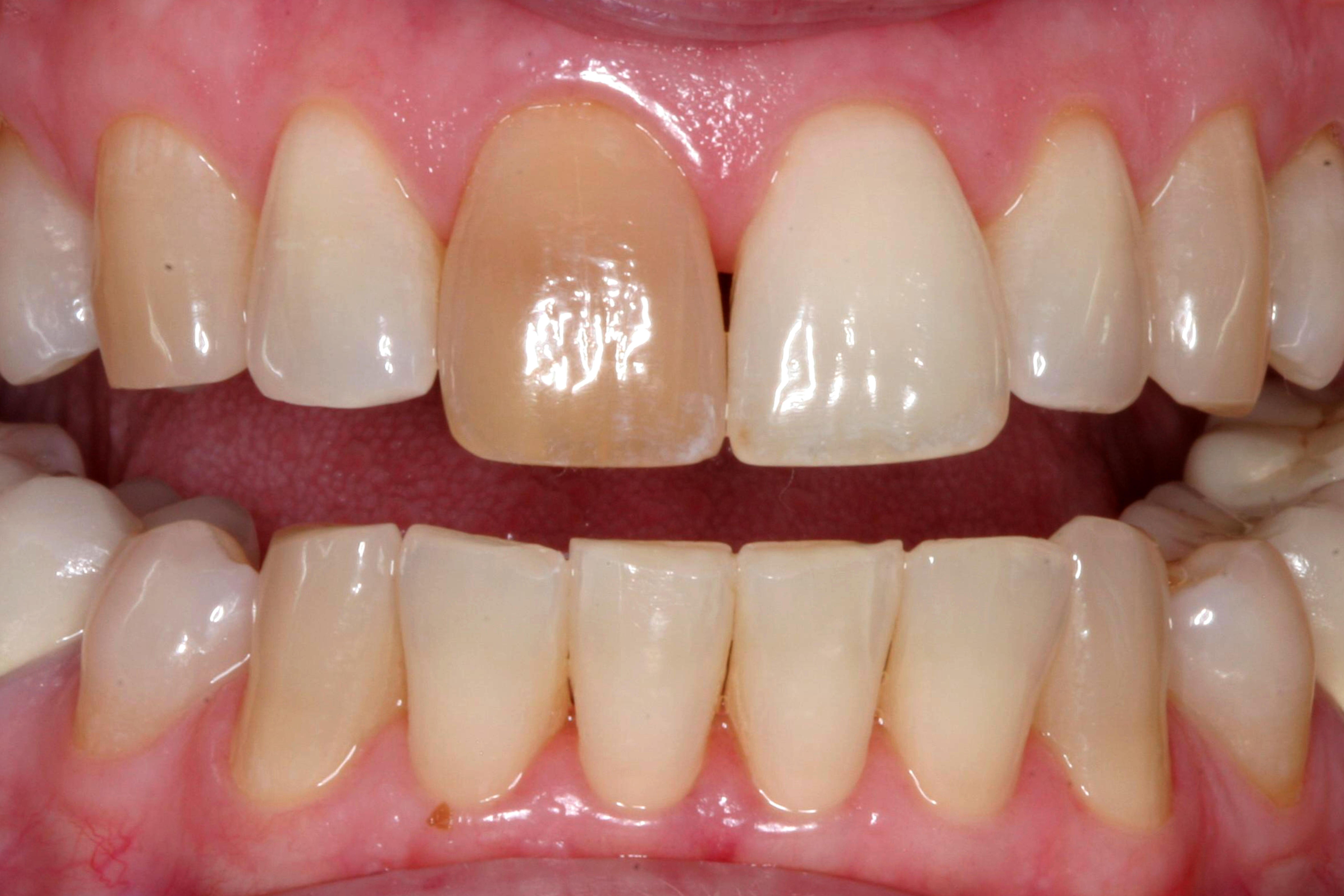 Bruns Family Dental Center | Dental Cleanings, Oral Cancer Screening and Digital Radiography