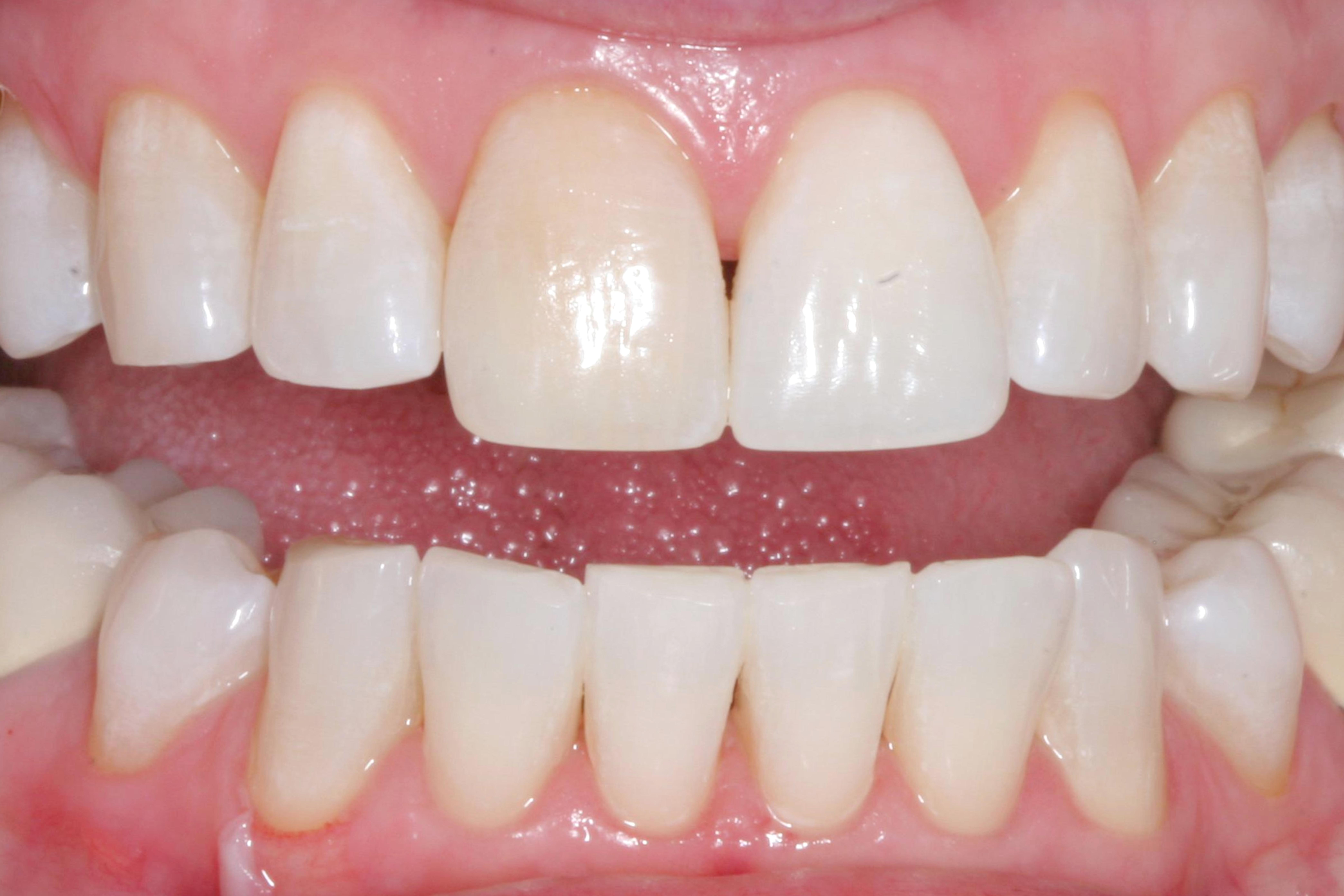 Bruns Family Dental Center | Root Canals, Digital Radiography and Oral Cancer Screening