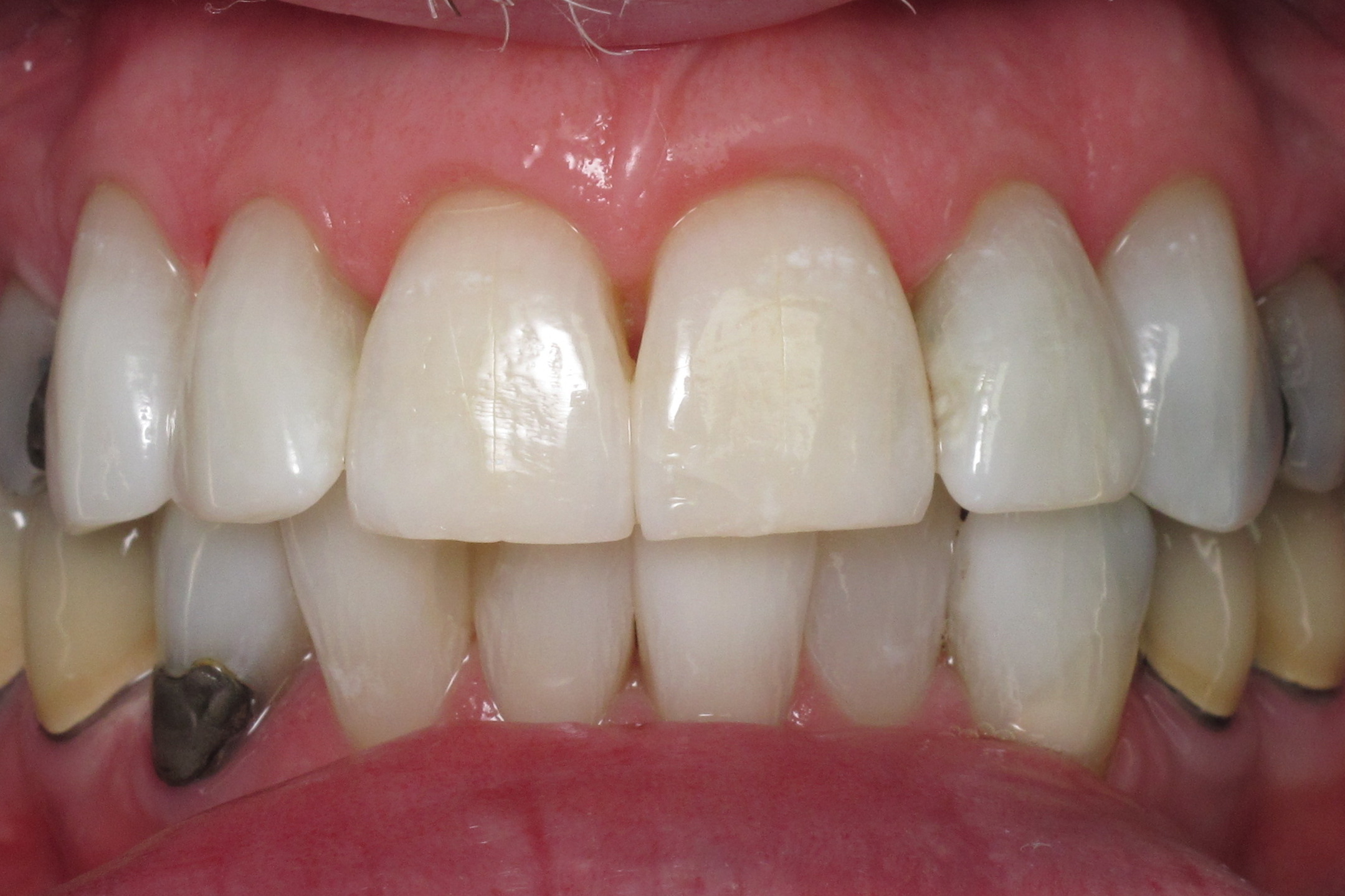 Bruns Family Dental Center | Pediatric Dentistry, Dental Cleanings and Teeth Whitening